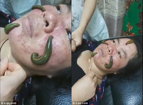 Kinh hãi kiểu làm đẹp bằng cách... thả đỉa lên mặt để hút sạch mụn - 1 Hình ảnh những con đỉa bò trên mặt khiến không ít người cảm thấy rùng mình