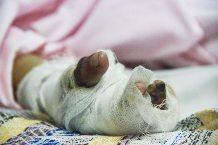 Bàn tay bệnh nhi bị cháy, nhiều ngón đã chết cơ xương không thể phục hồi