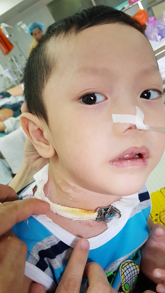 Trào nước mắt bé 4 tuổi bị biến chứng nặng sau khi mổ tim - 6 Hai bên cổ bệnh nhân 4 tuổi đáng thương này đã bị lấy hết ven chính, giờ không còn ven nữa nên cháu phải uống thuốc chứ không tiêm vào ven trung tâm ở cổ được nữa