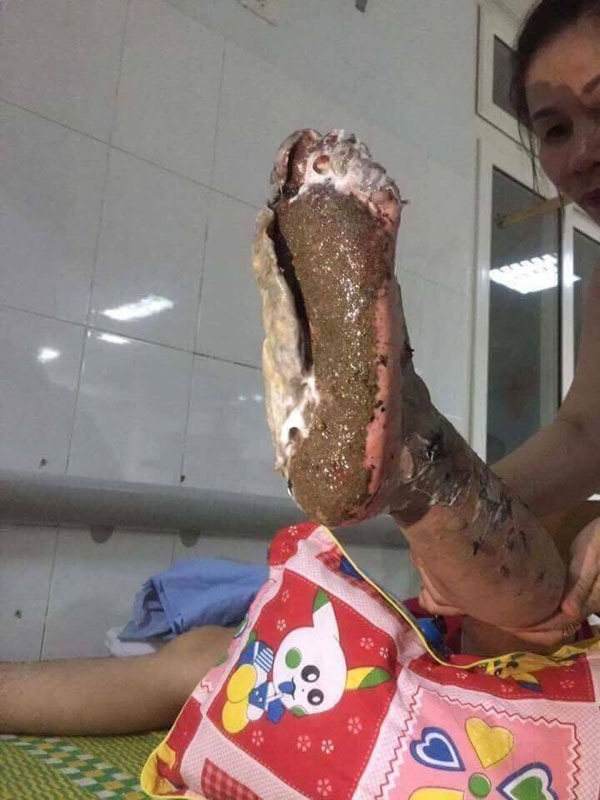 Vụ đốt rác khiến 3 cô cháu bỏng nặng: Làm rõ tố cáo "không cứu người gặp nạn" - 1 Chân nạn nhân Hiên bị bỏng nặng sau khi điều khiển xe máy té vào đống tro than đang cháy đêm 31/7.