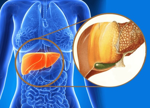 Gan nhiễm mỡ - "Thủ phạm" gây tăng nhanh ghép gan ở người trẻ - 1 Gan nhiễm mỡ - "Thủ phạm" gây tăng nhanh ghép gan ở người trẻ - 1