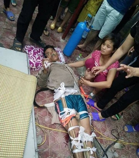 Trèo chặt cây thuê, người đàn ông rơi từ độ cao 6m gãy cả 2 chân - 1 Ông Sơn gãy cả 2 chân sau tai nạn thương tâm.