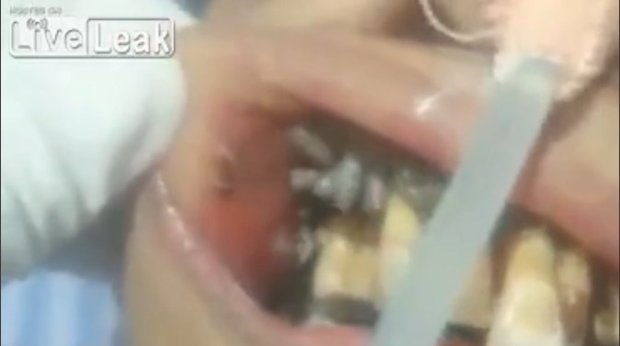 Rợn người với clip giòi bò lổn nhổn trong miệng một bệnh nhân - 1 Rợn người với clip giòi bò lổn nhổn trong miệng một bệnh nhân - 1