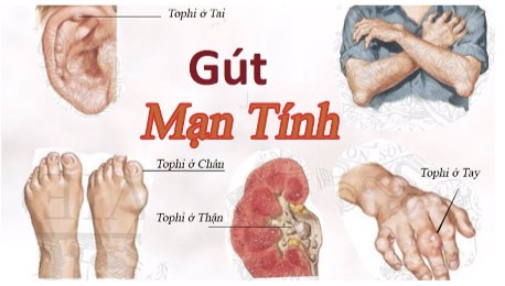 Phần lớn người bệnh bị gút mạn tính nhưng không biết - 2
Một trong những dấu hiệu nổi bật của gút mạn tính