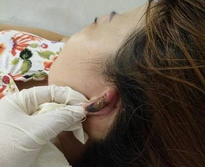 Mất vành tai, lóc da đầu vì... uốn hấp tóc - 2
Hoại tử tai vì hóa chất hấp tóc rơi vào