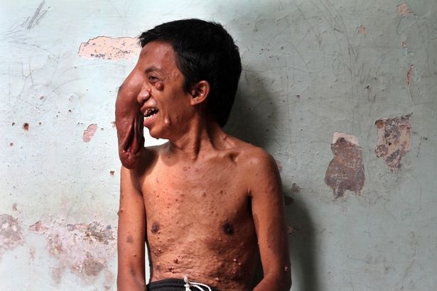 Indonesia: "Người mặt voi" khiến ai nhìn cũng khiếp sợ - 1 Indonesia: "Người mặt voi" khiến ai nhìn cũng khiếp sợ - 1