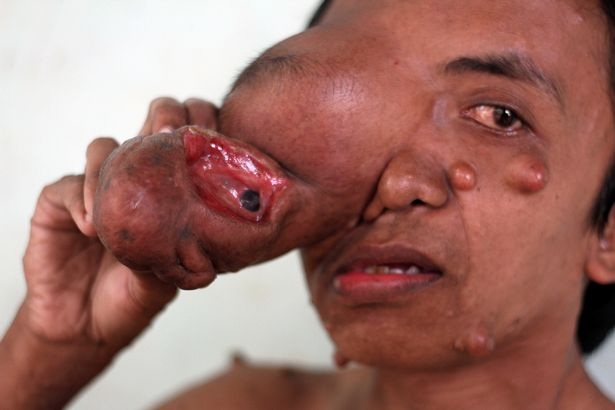 Indonesia: "Người mặt voi" khiến ai nhìn cũng khiếp sợ - 2 Indonesia: "Người mặt voi" khiến ai nhìn cũng khiếp sợ - 2
