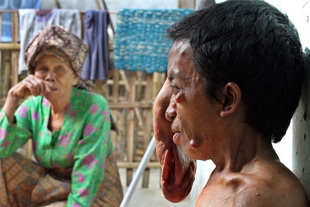 Indonesia: "Người mặt voi" khiến ai nhìn cũng khiếp sợ - 3 Indonesia: "Người mặt voi" khiến ai nhìn cũng khiếp sợ - 3