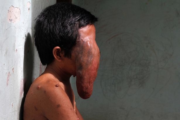 Indonesia: "Người mặt voi" khiến ai nhìn cũng khiếp sợ - 4 Indonesia: "Người mặt voi" khiến ai nhìn cũng khiếp sợ - 4