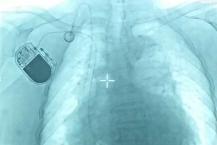 Bệnh viện tuyến quận đầu tiên cấy được máy tạo nhịp tim - 2 Hình ảnh máy tạo nhịp sau khi được đặt thành vào cơ thể bệnh nhân
