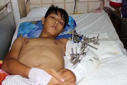 
Cậu bé 15 tuổi, đối mặt với nguy cơ phải đoạn bỏ cánh tay trái

