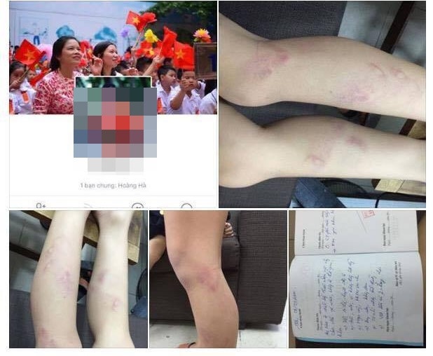 Vụ 11 học sinh lớp 2 bị bạo hành: Họp khẩn gần 50 hiệu trưởng trên địa bàn quận - 1 Vết thâm tím trên chân học sinh bị cô V đánh (ảnh chụp màn hình)