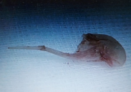 Chiếc xương cá là thủ phạm khiến ông Hữu T. phải nhập viện nhiều lần