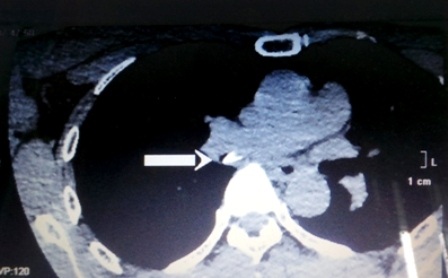 Bác sĩ “mò” không ra miếng xương cá ghim chặt vào phế quản - 2