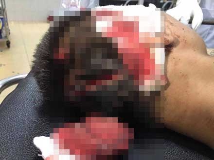 Truy tìm nhóm côn đồ vác dao chém vỡ hộp sọ nạn nhân - 1
Nạn nhân bị côn đồ chém vỡ hộp sọ.