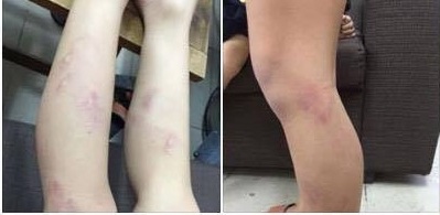 Vụ 11 học sinh lớp 2 bị bạo hành: Họp khẩn gần 50 hiệu trưởng trên địa bàn quận - 2 Cháu Đ được bác sĩ xác định bị ảnh hưởng phần mềm cả hai chân