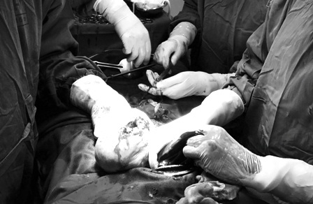 Các bác sĩ đã phẫu thuật khẩn bắt thai nhi trong tình trạng người mẹ bị sốt xuất huyết nặng