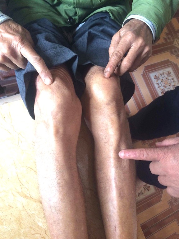Người lính tù Côn Đảo hơn 20 năm đi tìm công lý! - 2 Đôi chân ông Trác bị xâu dây thép nên không thể đi lại như người bình thường.