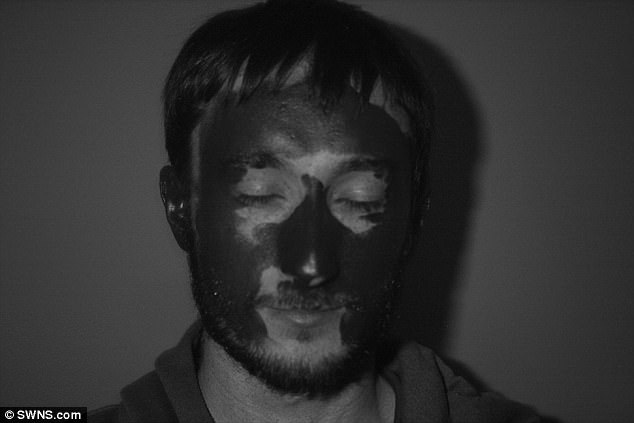 Đáng lo ngại là hơn 90% tế bào ung thư biểu mô tế bào đáy xuất hiện ở đầu hoặc cổ.