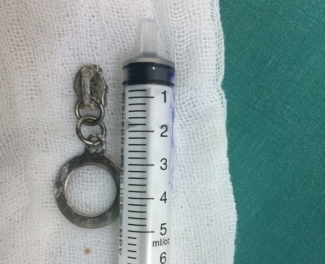 Bé 2 tuổi ăn vào là nôn vì khóa kéo sắt nằm trong thực quản - 1 Chiếc khóa kéo bằng kim loại được gắp ra từ thực quản bệnh nhi 24 tháng tuổi (ảnh bệnh viện cung cấp)