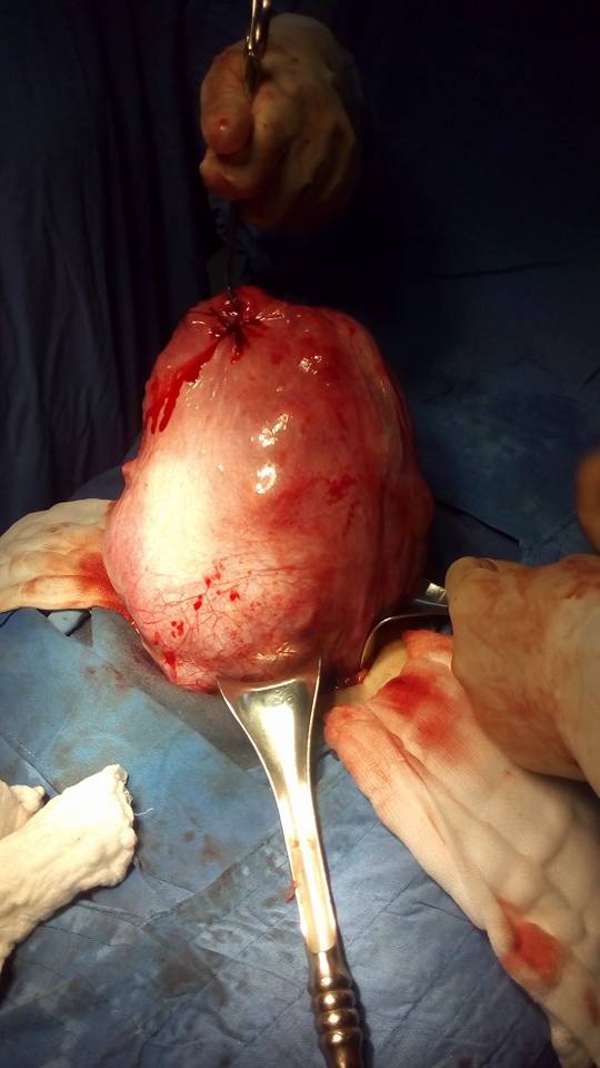 Sợ phẫu thuật, mang khối u gần 4kg kèm rong kinh suốt nhiều năm - 2 Khối u có trọng lượng gần 4kg được lấy ra khỏi bệnh nhân. (Ảnh: BVĐK khu vực Quảng Nam)