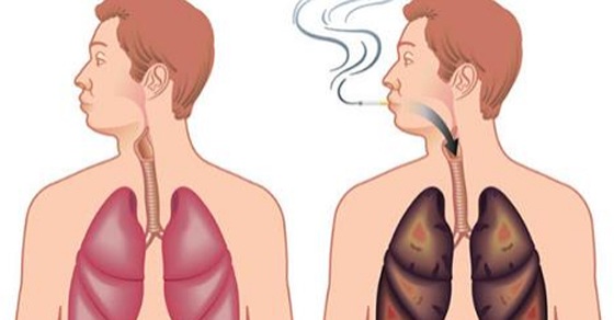 Cách nào thải độc nicotin do hút thuốc lá? - 2 Cách nào thải độc nicotin do hút thuốc lá? - 2