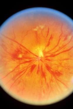 12 dấu hiệu bệnh mà bạn phải “hỏi” mắt - 5