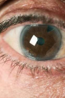 12 dấu hiệu bệnh mà bạn phải “hỏi” mắt - 4