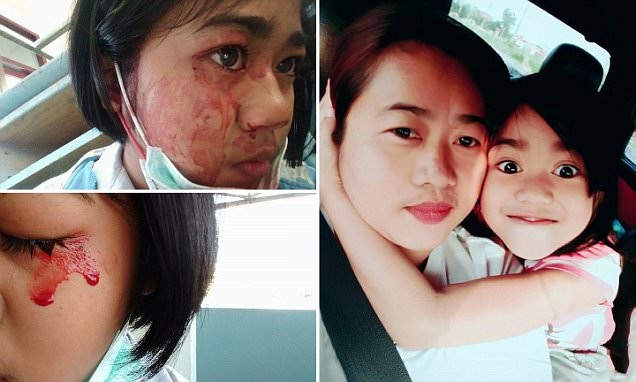 Cô bé 7 tuổi khóc, đồ mồ hôi máu mỗi khi đau đầu - 1 Cô bé 7 tuổi khóc, đồ mồ hôi máu mỗi khi đau đầu - 1