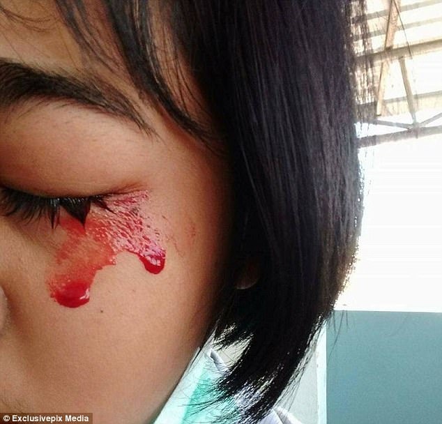 Cô bé 7 tuổi khóc, đồ mồ hôi máu mỗi khi đau đầu - 2 Cô bé 7 tuổi khóc, đồ mồ hôi máu mỗi khi đau đầu - 2