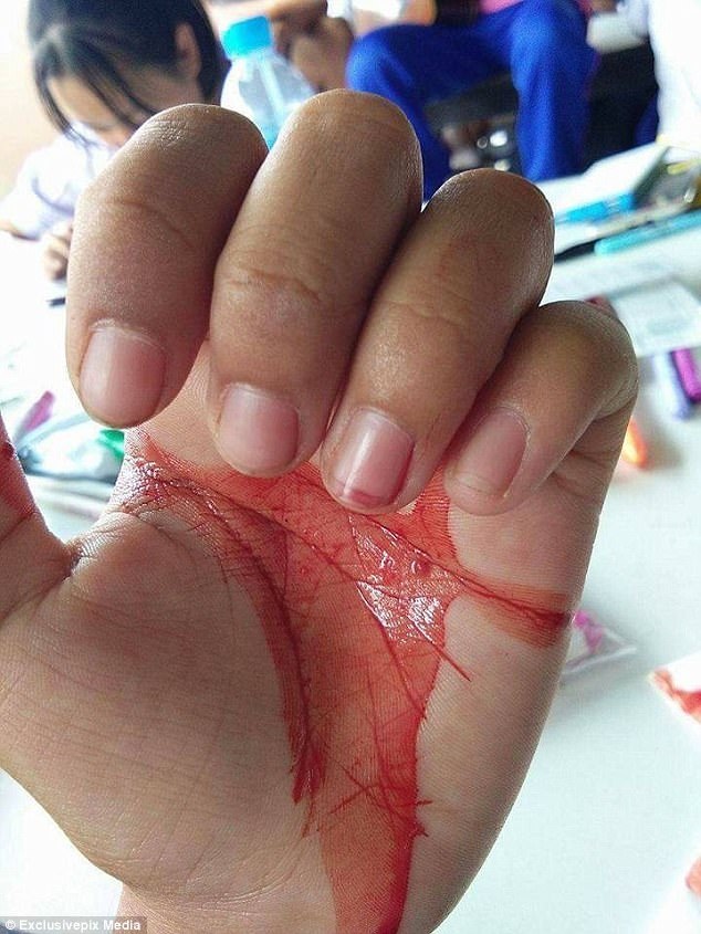 Cô bé 7 tuổi khóc, đồ mồ hôi máu mỗi khi đau đầu - 3 Cô bé 7 tuổi khóc, đồ mồ hôi máu mỗi khi đau đầu - 3