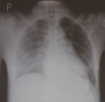 Bệnh nhân nhập viện với 10 vết thương, tràn dịch màng phổi, màng tim