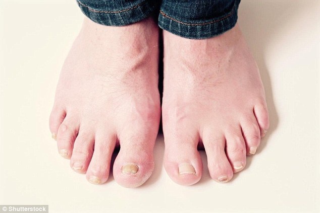 Cách tốt nhất để trị dứt điểm móng chọc thịt - 1 Móng chọc thịt xảy ra khi các móng đang mọc thường là ở ngón chân cái) đâm sâu và xé rách da và mô mềm xung quanh.
