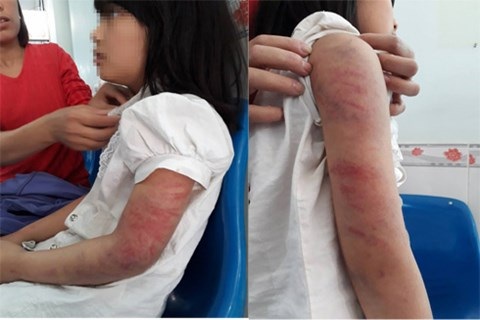 Khởi tố người đàn ông nghiện rượu đánh đập con gái dã man - 1 Hai cánh tay cháu bé chi chít vết thương bầm tím.