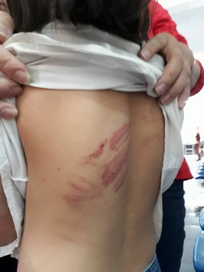 Khởi tố người đàn ông nghiện rượu đánh đập con gái dã man - 2 Những vết thương trên cơ thể em do người cha nghiện rượu gây nên.