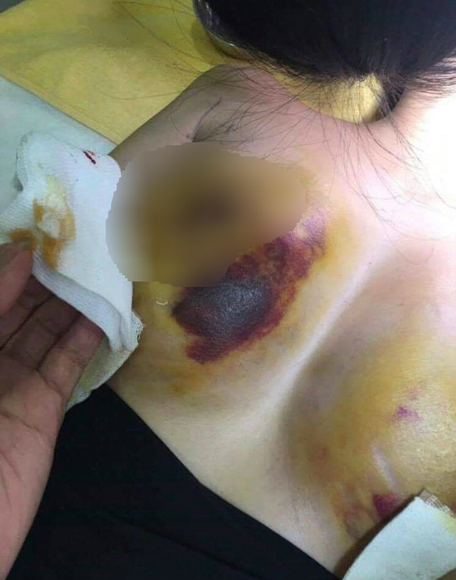 Vụ tố tai biến khi nâng ngực: Hai bên đều yêu cầu lập Hội đồng chuyên môn - 1 Vụ tố tai biến khi nâng ngực: Hai bên đều yêu cầu lập Hội đồng chuyên môn - 1