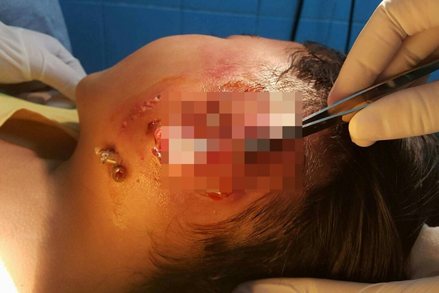 Bé 9 tuổi giành giật sự sống với vi khuẩn ăn thịt người - 1 Bé Thùy được chuyển đến Bệnh viện Sản Nhi Nghệ An trong tình trạng nhiễm trùng máu, hoại tử tổ chức tuyến mang tai do bị nhiễm vi khuẩn Whitmore - còn gọi là vi khuẩn ăn thịt người
