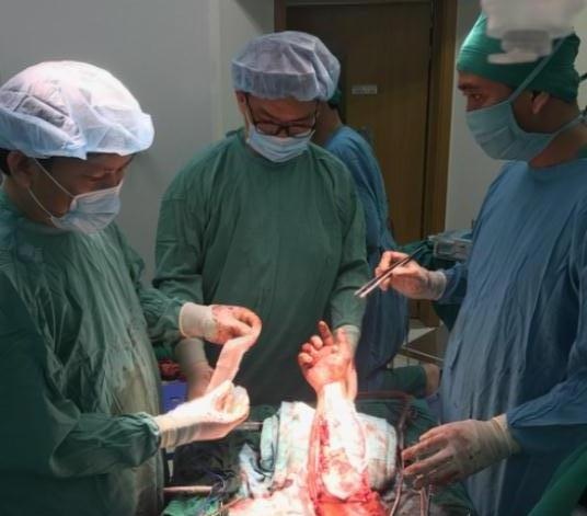 Người đàn ông nghèo bị máy cắt rơm cắt lìa cẳng tay phải - 1 Các bác sĩ phẫu thuật nối cánh tay cho bệnh nhân Tuấn