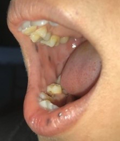 Hiếm gặp bệnh mọc nhiều nốt sắc tố trong miệng - 1 Nốt sắc tố trong miệng, quanh niêm mạc, môi có thể là dấu hiệu bệnh nguy hiểm