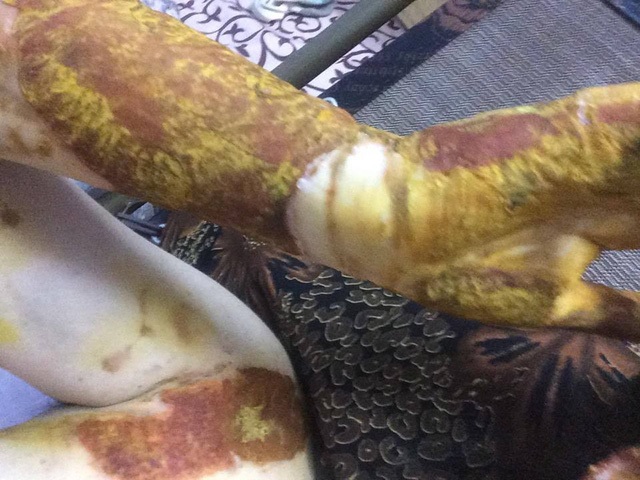Cảnh cáo người gây tai nạn vụ nữ sinh bị bỏng cồn trong phòng thực hành Hóa - 1 Nữ sinh bị bỏng cồn ở phòng thực hành Hóa của trường