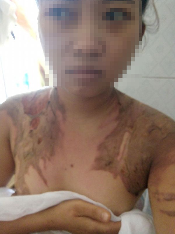 
Chị Trần Thị Vui bị chồng dùng ấm nước sôi đổ lên người
