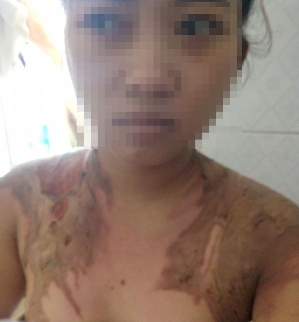 Bắt giam người đàn ông dội nước sôi lên cơ thể vợ - 1
Chị Vui bị bỏng nhiều vị trí trên cơ thể