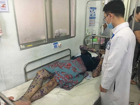Phát hiện ổ dịch thủy đậu trong khu chế xuất - 1 Phát hiện ổ dịch thủy đậu trong khu chế xuất - 1