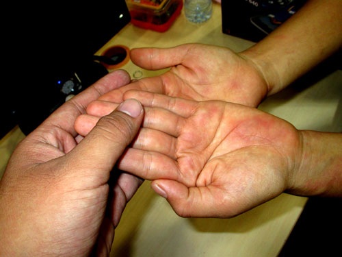 Coi chừng phát ban, nổi mẩn… đánh lừa - 1 Một trường hợp tổn thương da khiến người bệnh lầm tưởng là những dấu xuất huyết dưới da nhưng thật ra là bị đỏ da do dị ứng