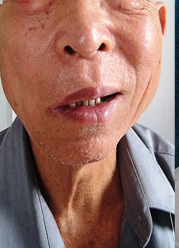 Liệt mặt, méo miệng chỉ sau 1 cốc bia - 1 Liệt mặt, méo miệng chỉ sau 1 cốc bia - 1