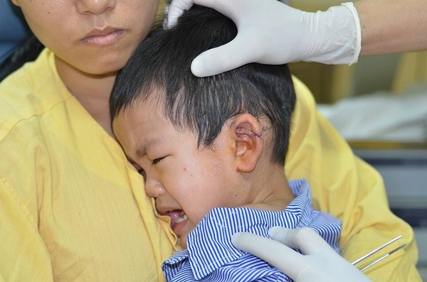 Một bé trai 3 tuổi bị tôn cắt ngang vành tai - 1 Một bé trai 3 tuổi bị tôn cắt ngang vành tai - 1