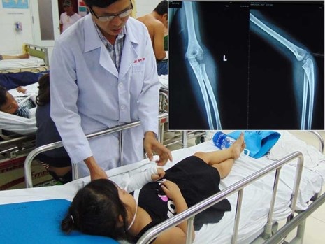 Bó thuốc Nam, coi chừng tay trẻ bị biến dạng - 1 Bó thuốc Nam, coi chừng tay trẻ bị biến dạng - 1