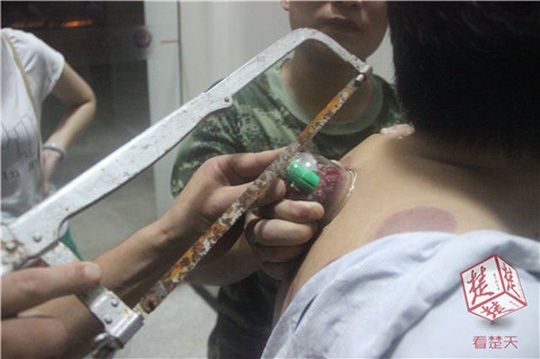 Giác hơi xong, cầu cứu… lính cứu hỏa - 1 Lính cứu hỏa đã phải mượn một chiếc cưa, cưa nứt chiếc cốc giác hơi để lấy nó ra khỏi khối thịt đã bị bầm đỏ, sưng tím - ảnh: CHUTIAN METROPOLIS DAILY