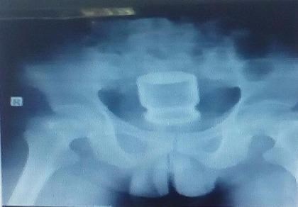 Những sự cố 'dở khóc dở cười' của cánh mày râu - 1 Vị trí lọ nước yến còn nguyên nắp trong cơ thể bệnh nhân. Ảnh: PLO.VN