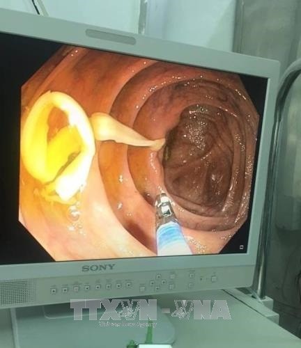 Nội soi gắp thành công sán xơ mít dài 1,2 mét - 1 Bác sĩ nội soi phát hiện sán xơ mít nằm trong manh tràng và hồi tràng của bệnh nhân.